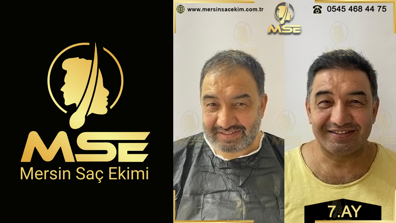Mersin Saç Ekimi